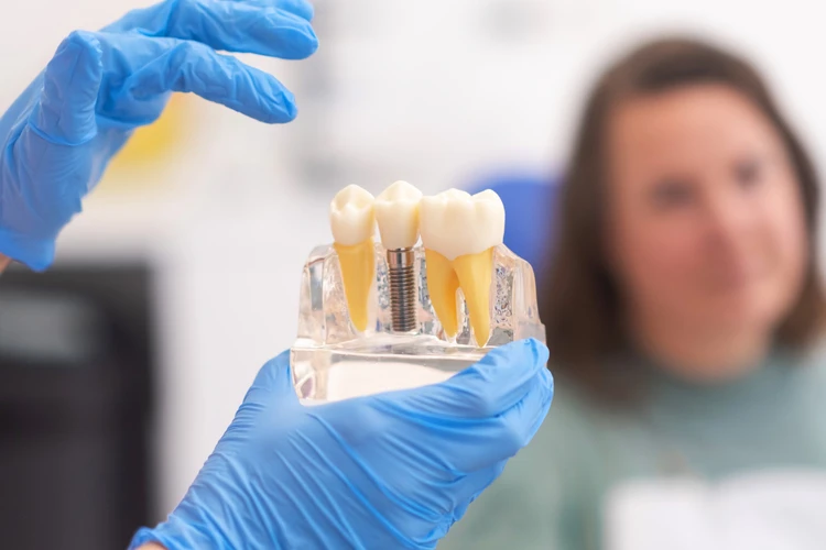 Model zębów z implantami używany do omówienia leczenia implantologicznego