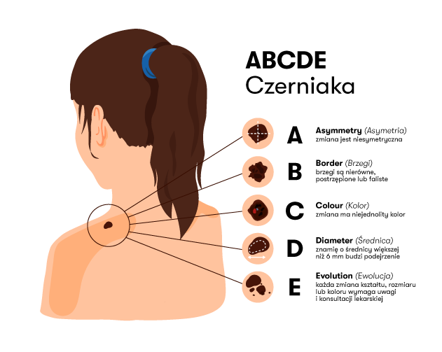 symptomy czerniaka: zasada ABCDE