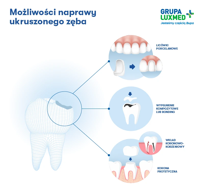 infografika-jak-naprawić-ukruszony-ząb