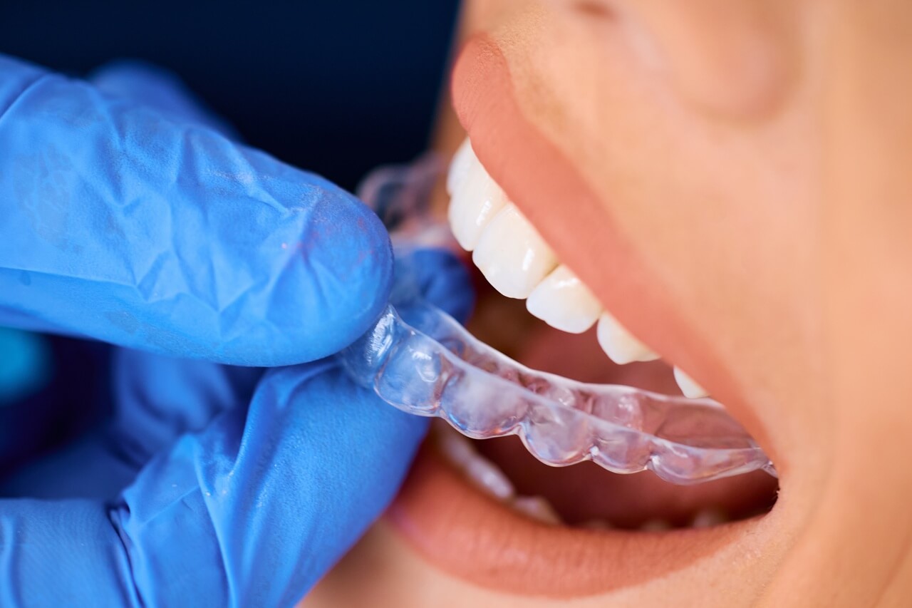 Pacjentka w trakcie przymiarki nakładek Invisalign