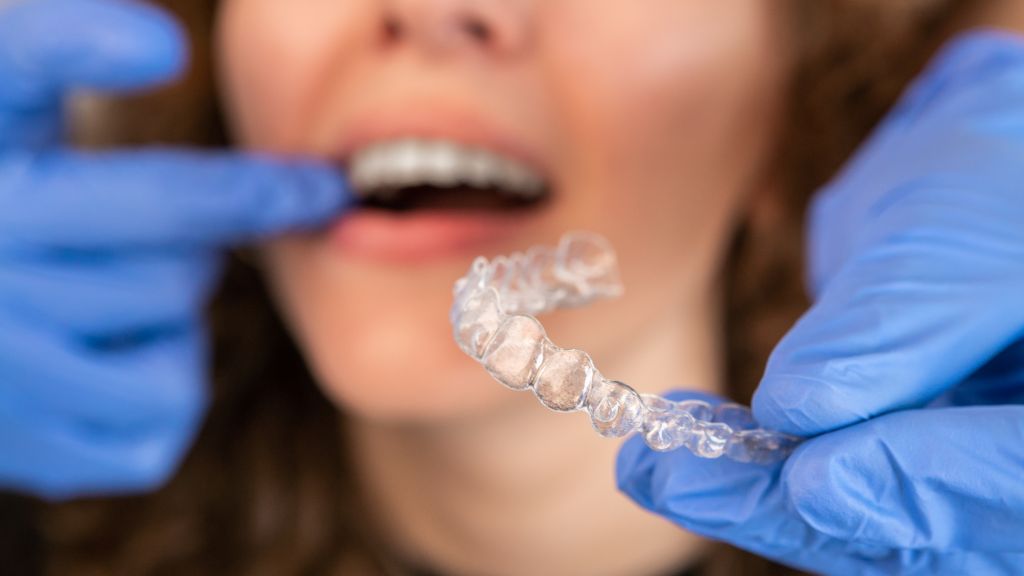 Przymierzanie aparatu Invisalign